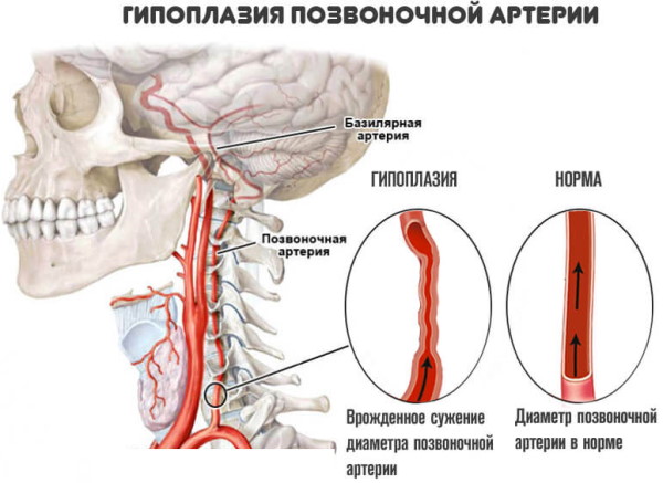 Гипоплазия правой позвоночной артерии. Что это, симптомы, лечение