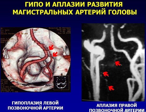 Гипоплазия правой позвоночной артерии. Что это, симптомы, лечение