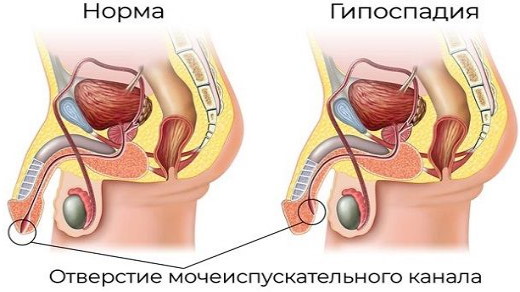 Гипоспадия без гипоспадии у ребенка. Что это такое, фото, формы