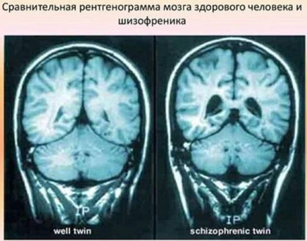 Как определить шизофрению у человека по МРТ, внешности, рисункам