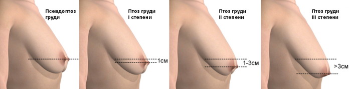 Как подтянуть обвисшую грудь, предотвратить обвисание у женщин