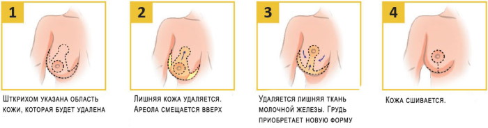 Как подтянуть обвисшую грудь, предотвратить обвисание у женщин