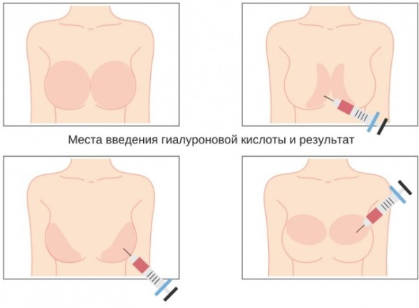 Как подтянуть обвисшую грудь, предотвратить обвисание у женщин