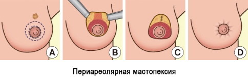 Как подтянуть обвисшую грудь, предотвратить обвисание у женщин