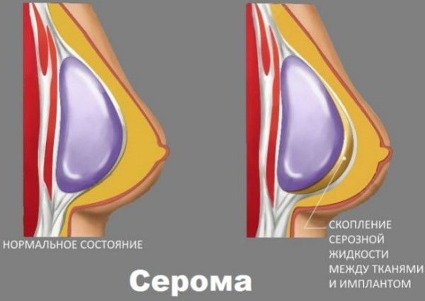 Как подтянуть обвисшую грудь, предотвратить обвисание у женщин