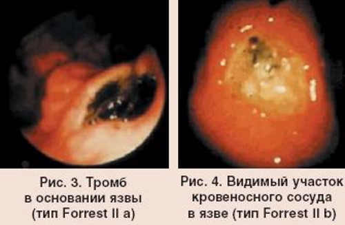 Классификация кровотечений по Форесту. Клинические рекомендации