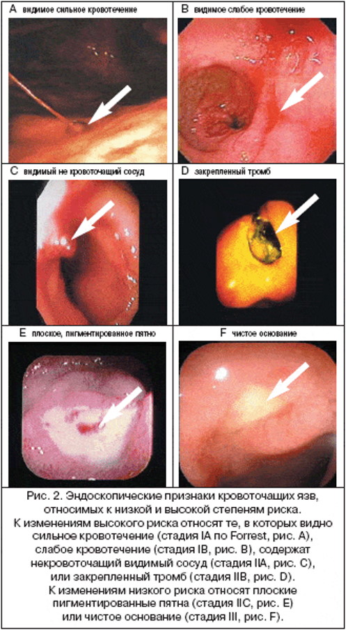 Классификация кровотечений по Форесту. Клинические рекомендации
