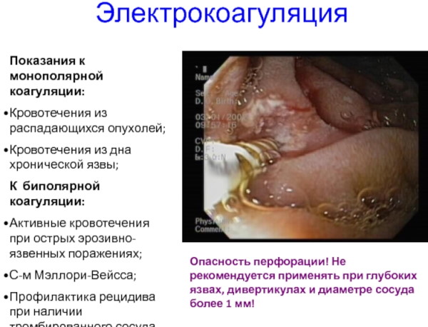 Классификация кровотечений по Форесту. Клинические рекомендации