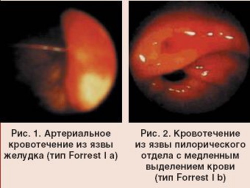 Классификация кровотечений по Форесту. Клинические рекомендации