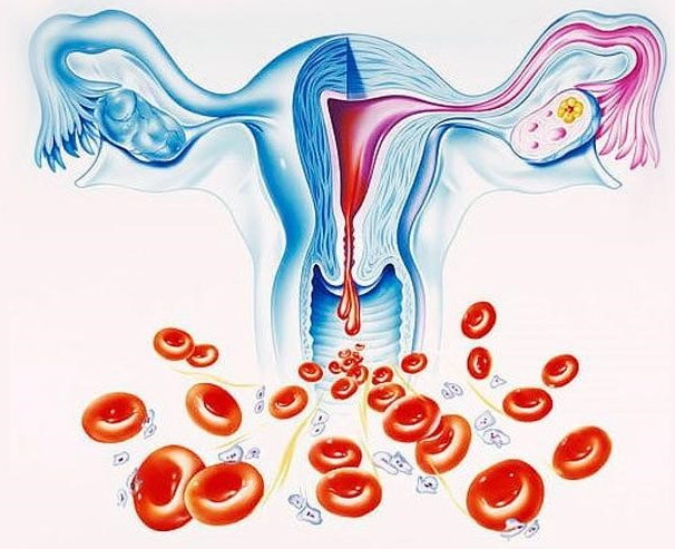 Маточные кровотечения. Причины и лечение в гинекологии