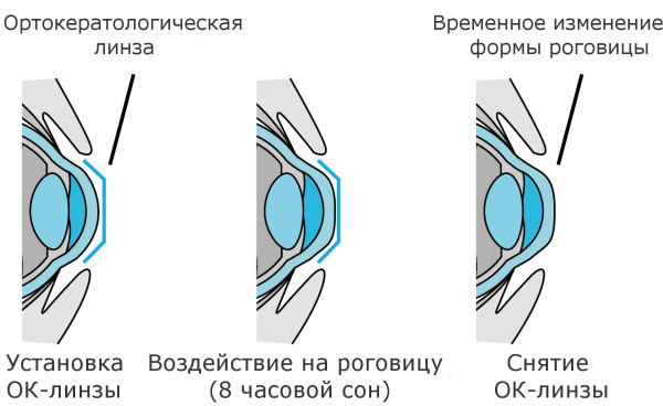 Методика Жданова по восстановлению зрения. Упражнения