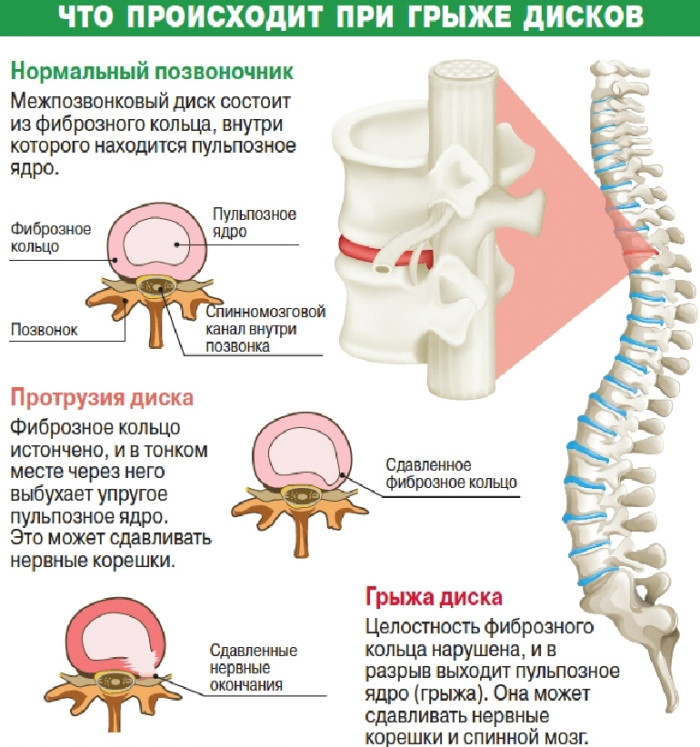 Межпозвоночная грыжа фото как выглядит