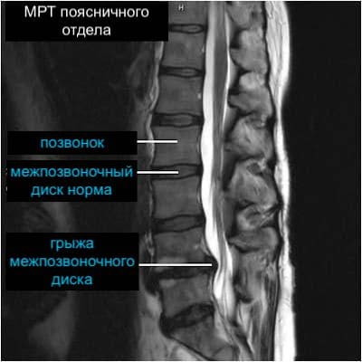 Межпозвоночная грыжа: симптомы и признаки, как определить