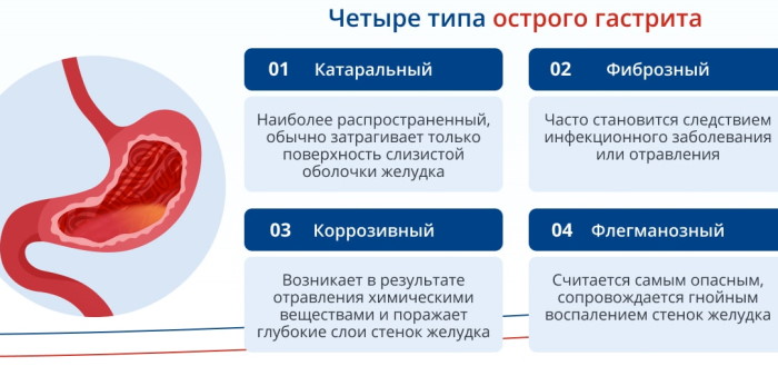 Обострение гастрита. Симптомы и лечение у взрослых летом, весной, зимой