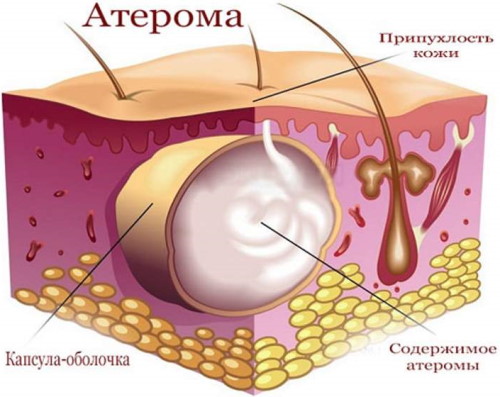 Шишка под мочкой уха на шее. Что делать