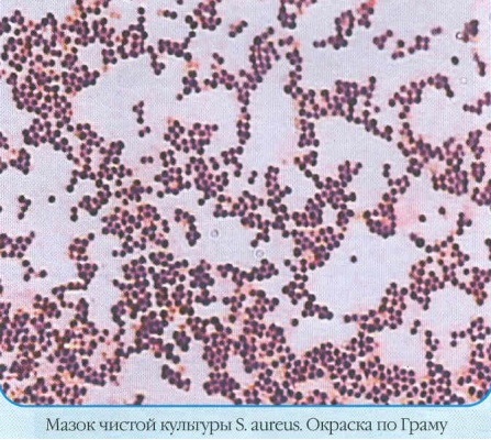 Стафилококк Ауреус (staphylococcus aureus): норма в мазке из зева, 10 в 3-8 степени