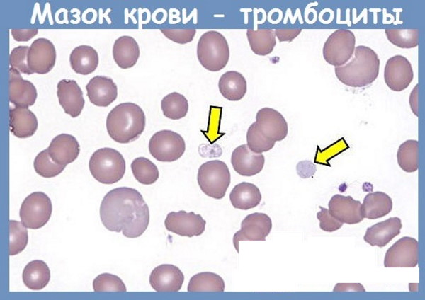 Тромбоциты по Фонио. Норма, что это, как сдать