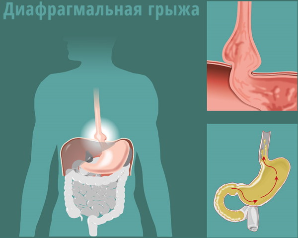 Тянущая боль в правом подреберье спереди. Причины, лечение