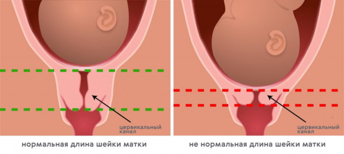 УЗИ матки и придатков. Как делают, подготовка, на какой день цикла