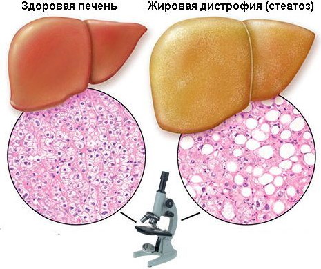 Жировая дистрофия печени. Причины, симптомы, лечение