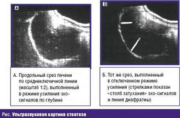 Жировая дистрофия печени. Причины, симптомы, лечение