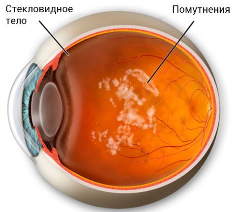Деструкция стекловидного тела глаза. Что это такое, лечение