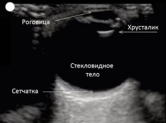 Деструкция стекловидного тела глаза. Что это такое, лечение