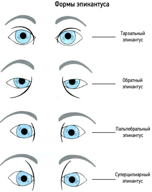 Эпикантус что это такое, фото у детей, азиатов, русских