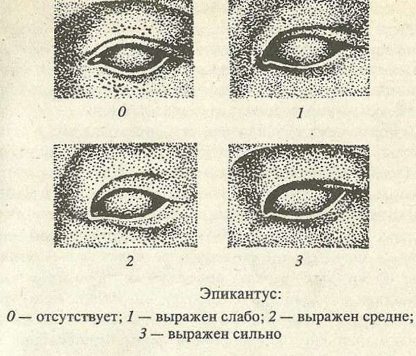 Эпикантус что это такое, фото у детей, азиатов, русских