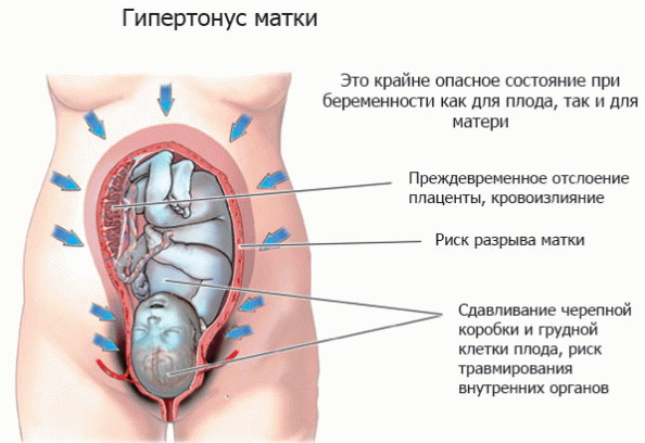 Гипертонус матки при беременности 1-2-3 триместр. Лечение