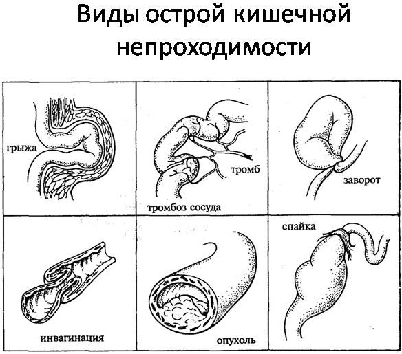 Кишечная непроходимость у детей. Симптомы, клинические рекомендации