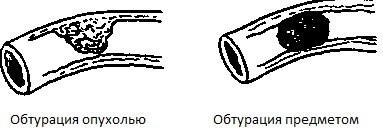 Кишечная непроходимость у детей. Симптомы, клинические рекомендации