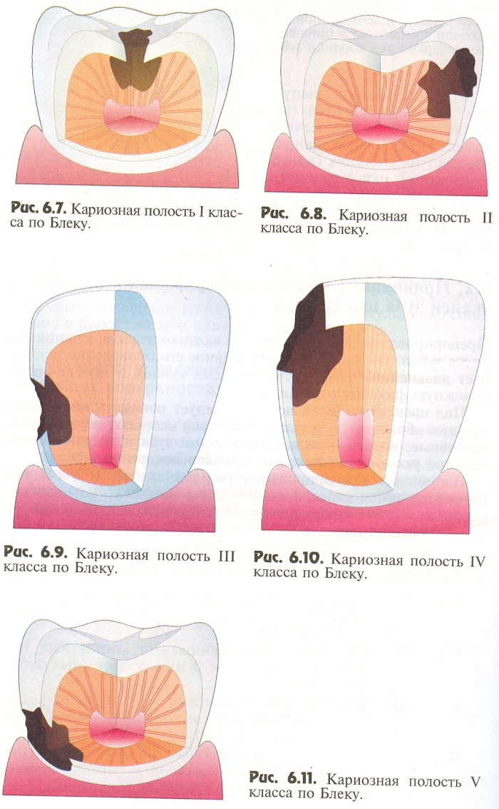 Классификация кариеса по Блэку в картинках. Таблица