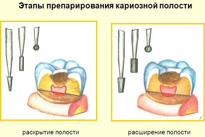 Классификация кариеса по Блэку в картинках. Таблица