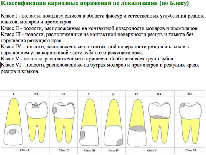 Классификация кариеса по Блэку в картинках. Таблица