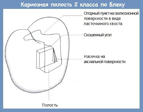 Классификация кариеса по Блэку в картинках. Таблица