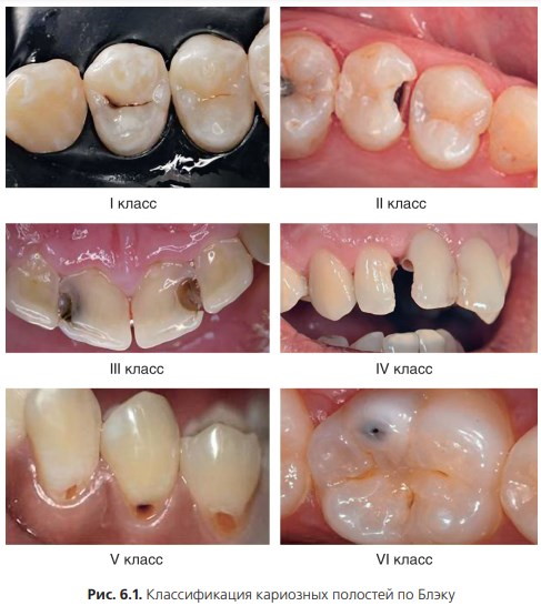 Классификация кариеса по Блэку в картинках. Таблица