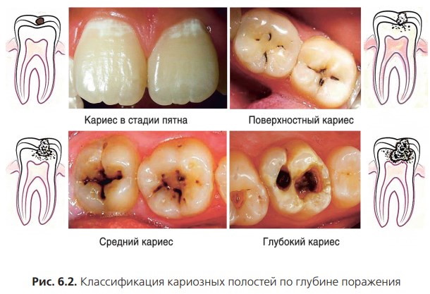 Классификация кариеса по Блэку в картинках. Таблица