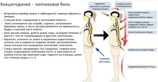 Кокцигодиния у женщин. Симптомы и лечение, отзывы врачей