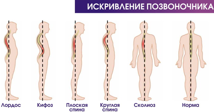 Лордоз и кифоз позвоночника. Что это, фото, лечение, упражнения