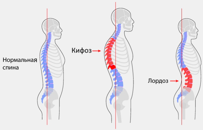 Лордоз и кифоз позвоночника. Что это, фото, лечение, упражнения