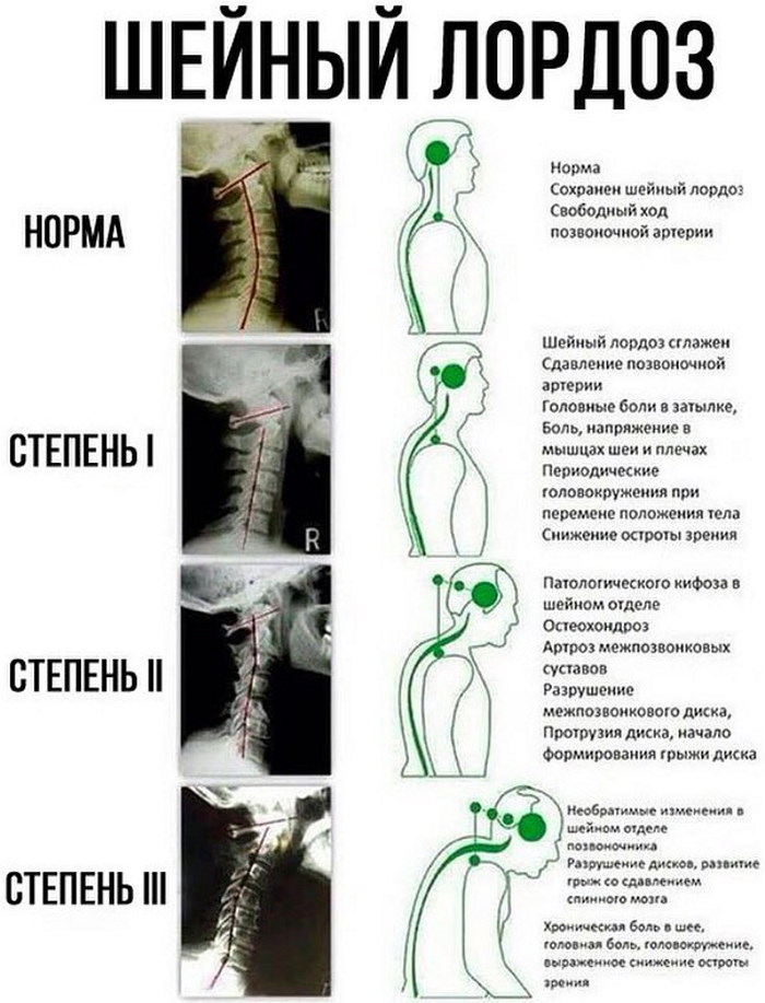 Лордоз и кифоз позвоночника. Что это, фото, лечение, упражнения