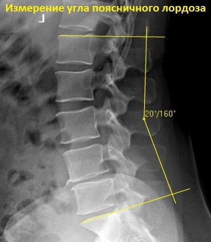 Лордоз и кифоз позвоночника. Что это, фото, лечение, упражнения