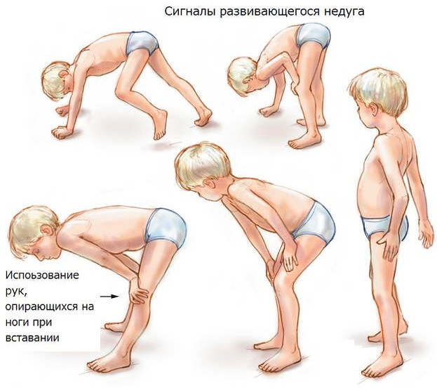 Миопатия. Что это такое, симптомы, причины, лечение