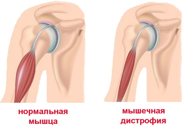 Миопатия. Что это такое, симптомы, причины, лечение