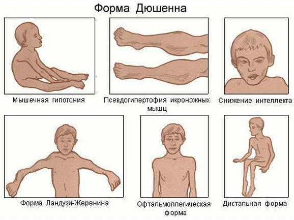 Миопатия. Что это такое, симптомы, причины, лечение