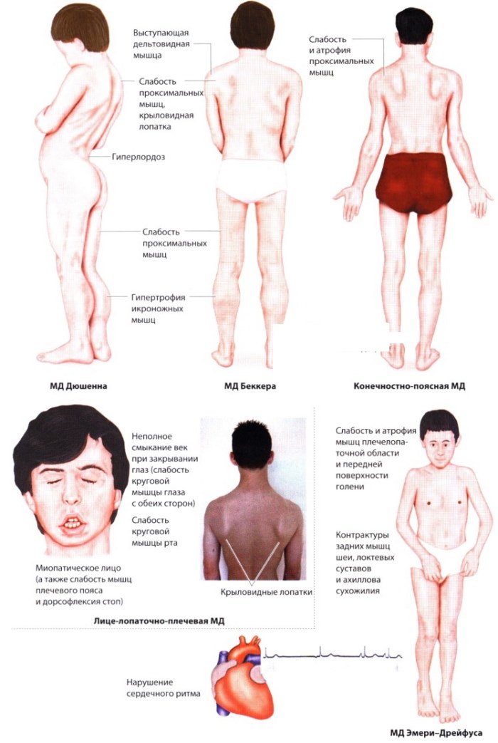 Миопатия. Что это такое, симптомы, причины, лечение