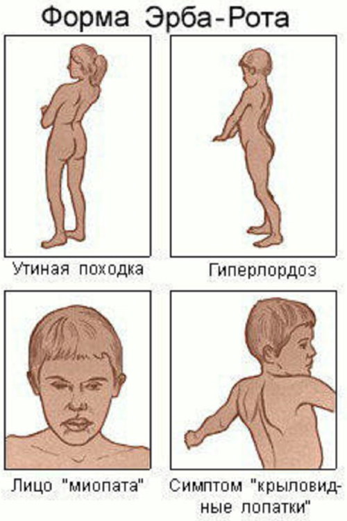 Миопатия. Что это такое, симптомы, причины, лечение