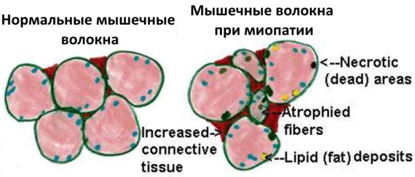 Миопатия. Что это такое, симптомы, причины, лечение