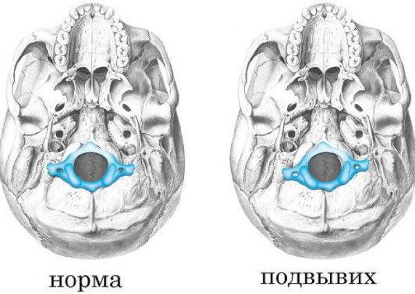 Подвывих шейного позвонка у ребенка. Симптомы, последствия